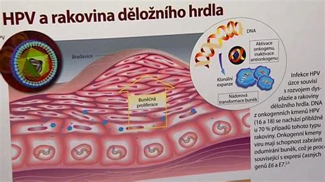 Infografika: průběh vzniku karcinomu děložního čípku